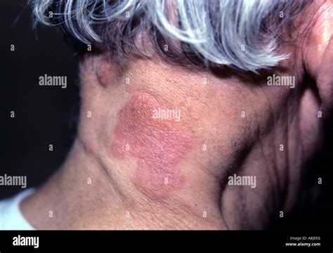 Neck rash hi-res stock photography and images - Alamy