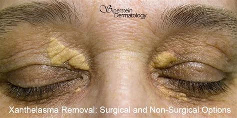 Xanthelasma Removal: Surgical and Non-Surgical Options - Siperstein ...