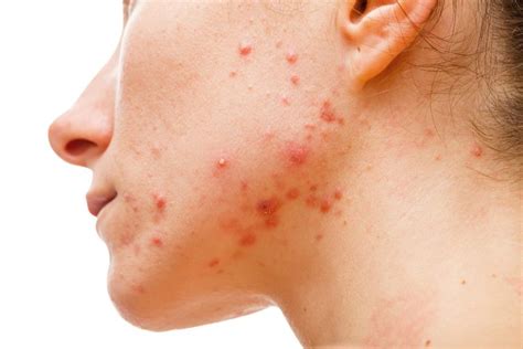 Cystic VS Hormonal Acne: What It Is & Best Treatment Options