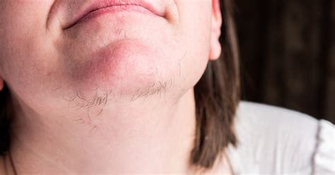 Hirsutism | Endocrine Society