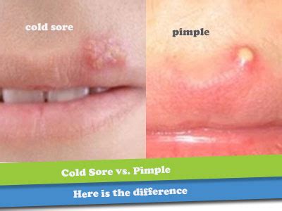 Causes and ways to improve acne of the lips