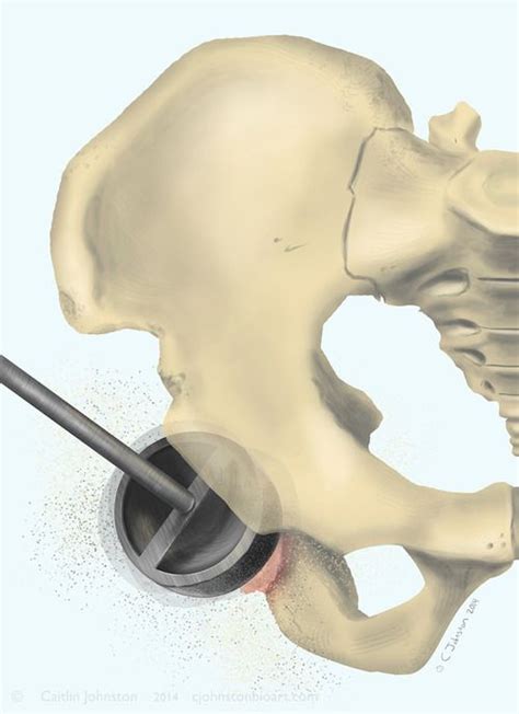 SoSanguineRN : cjohnstonbioart: Hip Arthroplasty and details ...