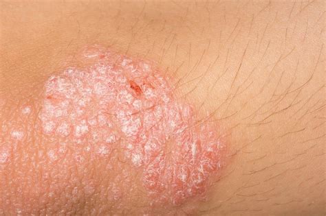 Generalized Pustular Psoriasis Confers Higher Disease Burden Than Plaque Psoriasis - Dermatology ...