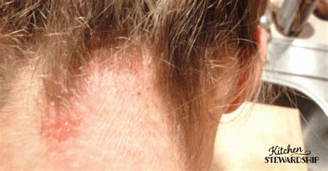 Itchy Red Rash On Scalp And Neck | Allergy Trigger