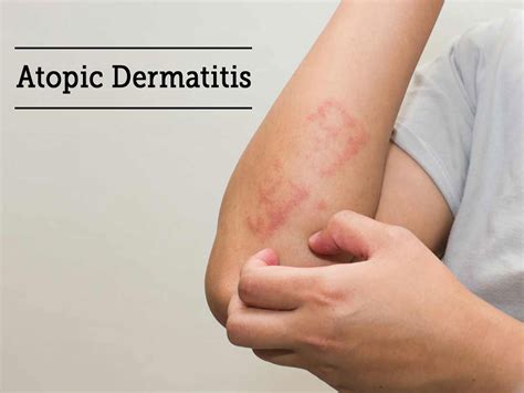 Moisturizers For Atopic Dermatitis at Travis Sawyer blog