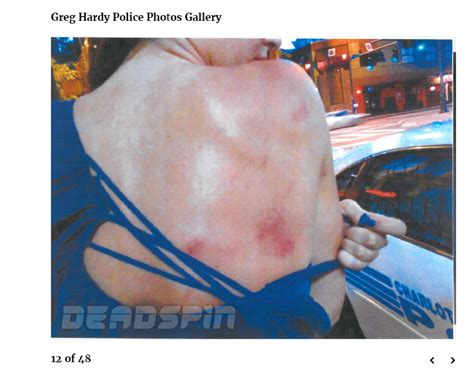 Deadspin posts police photos of injuries suffered by Greg Hardy's ex ...