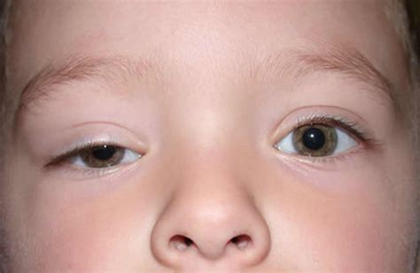 Ptosis, droopy eyelid causes, droopy eyelid treatment and ptosis surgery