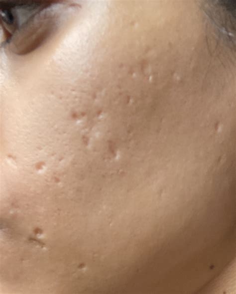 Atrophic Scars caused by chicken pox – Other acne treatments – Acne.org Forum