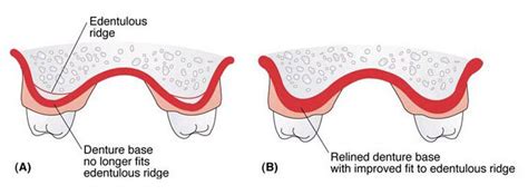 Denture Repair | Denture Reline | Woodstock Digital Denture Clinic