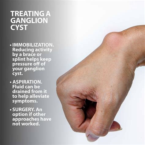 Ganglion Cyst Drainage Procedure Note