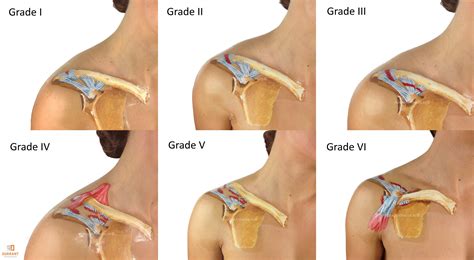 ac-joint-grades-I-VI Rotator Cuff Surgery Recovery, Shoulder Impingement Syndrome, Frozen ...