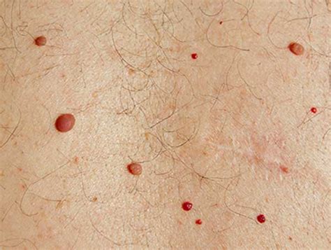 Laser cherry angioma removal – Caruna Medspa