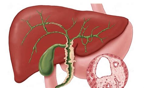 Primary sclerosing cholangitis symptoms – Prnso