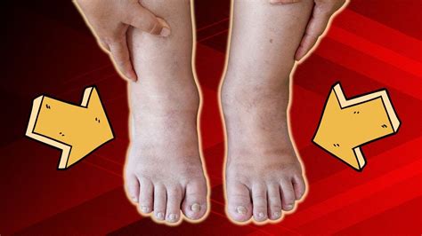 Top Causes Of Ankle Swelling & Pain (All You Need To Know) - YouTube