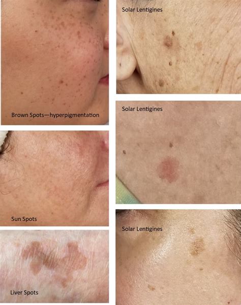 Light Brown Marks Appearing On Skin | Americanwarmoms.org