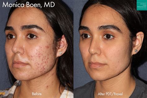 Very Mild Acne Scars