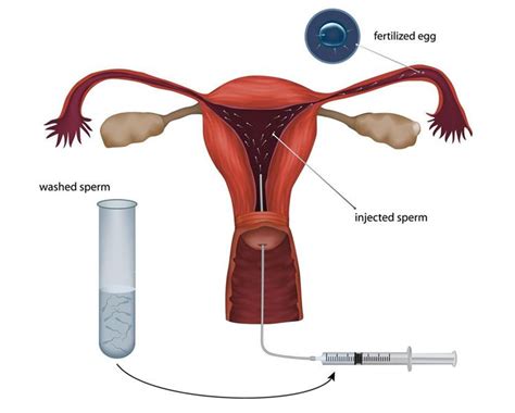 Artificial Insemination - Englewood, CO - Denver, CO - Denver Fertility ...