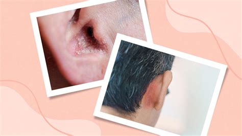 Ear Psoriasis: What It Feels Like, How to Treat It