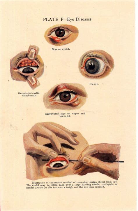 Eye Disease Human Anatomy Lithograph Medical Chart Having A Bad Eye Day ...