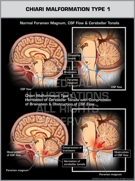 Pin on Chiari 1 Malformation