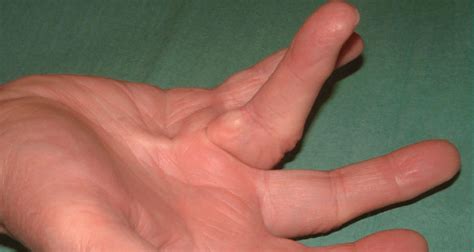 Dupuytren's Contracture - Causes, Symptoms, Treatment