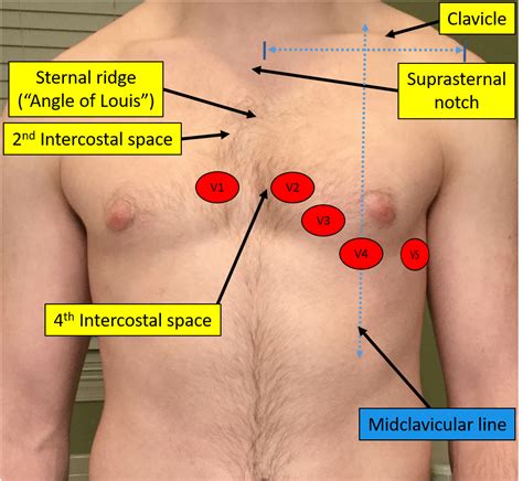 Proper Electrocardiogram (ECG/EKG) Lead Placement | ECGEDU