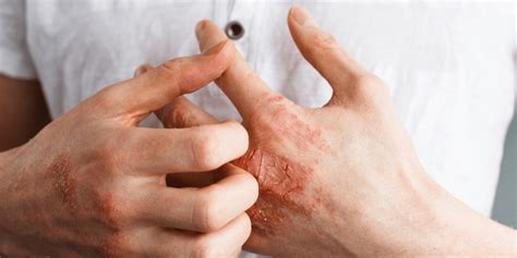 Eczema: Symptoms, Causes & Treatment - Affiliated Dermatology