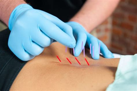 Dry Needling – Physical Therapy Clinic of Lafayette