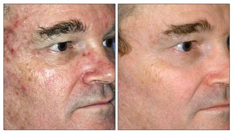 sciton-laser-skin-before-after-1 - Carolina Coastal Plastic Surgery