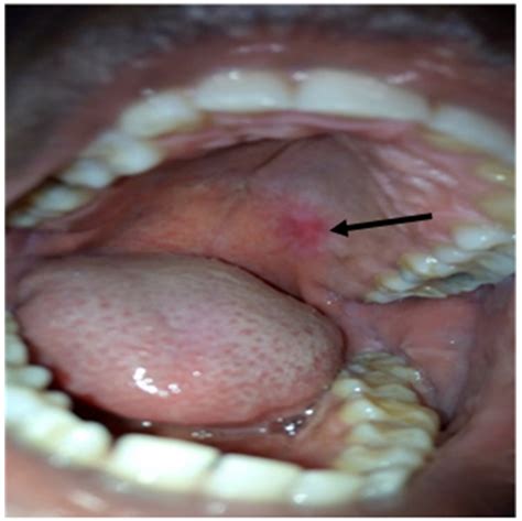 Figure 4. The mucosa 3 months after excision : Necrotizing ...