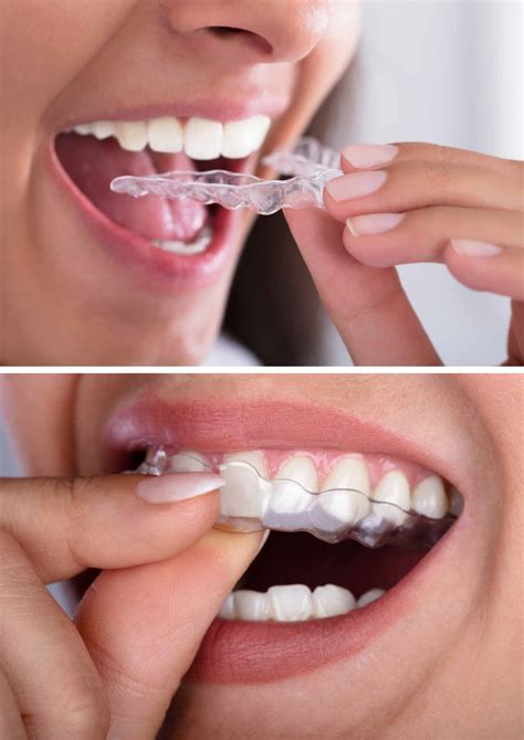 Practice growth with Active Aligners - Dentistry