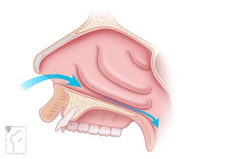 Turbinate Reduction | Stanford Health Care