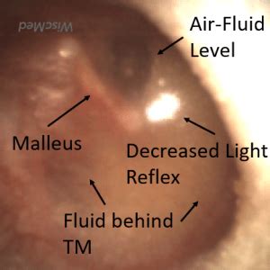 Otitis Media with Effusion - WiscMed