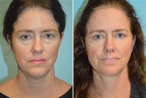 Before & After Eyelid Surgery Gallery Atlanta