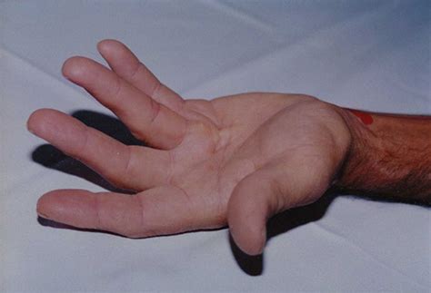 Dupuytren’s Disease Surgery | Hand Contracture Treatment | NZ