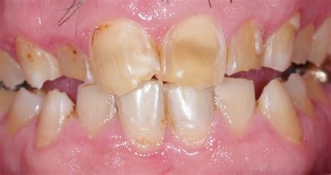 Dental Erosion - Logan | Crestmead Dental