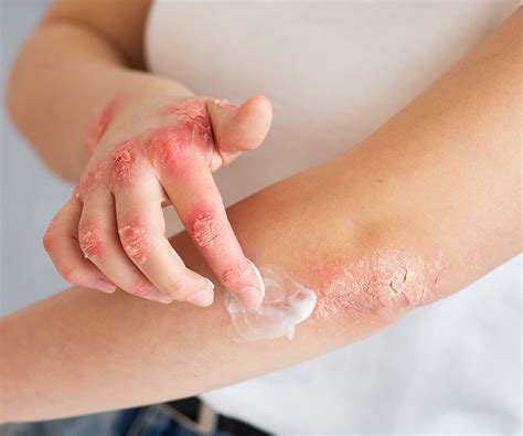 Weeping Eczema: Symptoms, Causes, and Treatment