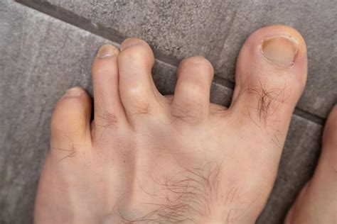 Symptoms of Hammertoe: Ani Orthopaedics: Orthopaedics