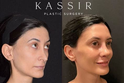 Revision Rhinoplasty for Polly Beak Deformity — Kassir Plastic Surgery ...