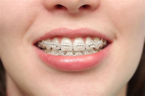 Types of Braces - Trusted Orthodontist in Texas