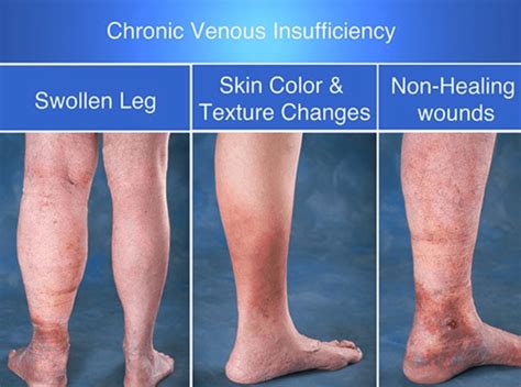 Discolored Skin? You May Have Chronic Venous Insufficiency