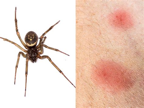 5 Common House Spiders And How To Treat Spider Bites - vrogue.co