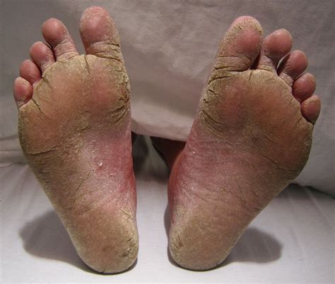 10 Natural Remedies to Get Rid of Fungal Infection Between Toes