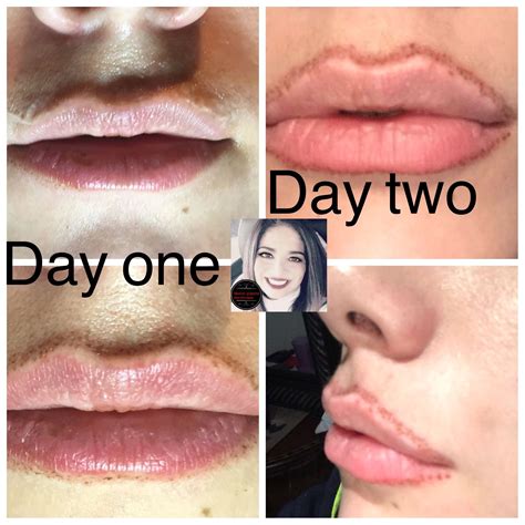 Lip Flip Before And After Photos