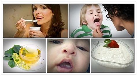 Make Use of 16 Home Remedies for Oral Thrush to Get Healthy Mouth– V-kool