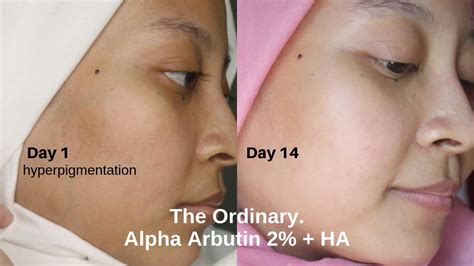 Is Alpha Arbutin An Effective Treatment For Hyperpigmentation? | Justinboey