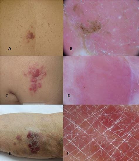 How Quickly Does Lymphoma Develop