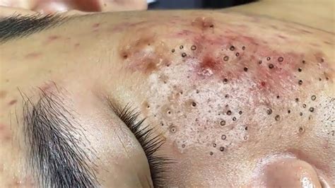 Relaxing Make your Acne Treatment Sac Dep Spa #1011 | Blackheads & Pimple Removal - YouTube