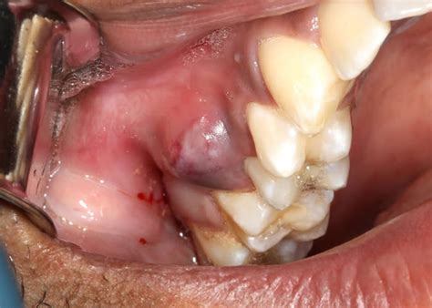 Abscess After Wisdom Tooth Removal - Picasso Dental Clinic Vietnam