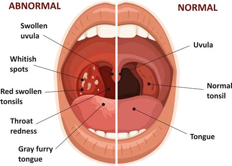 Bacterial Tonsillitis Tongue